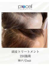 ユミト(Umit)/プロセルスカルプ