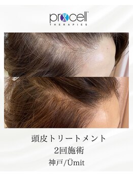ユミト(Umit)/プロセルスカルプ