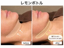 プレジールの雰囲気(プラズマで浸透力を高め、レモンボトルをマシンでお肌に導入。)