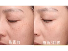 エタニティ 西宮店(Eternity)/IPL光エステ 施術3回後