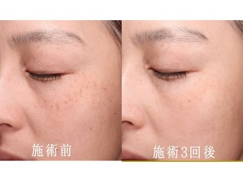 エタニティ 西宮店(Eternity)/IPL光エステ 施術3回後