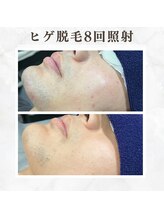 ボゴス(BOGOSS)/ヒゲ脱毛８回照射