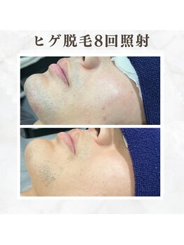 ボゴス(BOGOSS)/ヒゲ脱毛8回照射