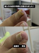 巻き爪じゅん 千葉駅前店/陥入爪による痛み改善の歩み