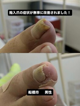 巻き爪じゅん 千葉駅前店/陥入爪による痛み改善の歩み