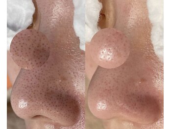 毛穴専科/毛穴黒ずみ除去!学割u24あり