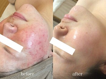 グランヴェルジェ(Granverger)/陶肌トリートメント