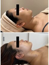 エイシスグロウ(asis glow.)/効果写真