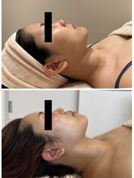 エイシスグロウ(asis glow.)/効果写真