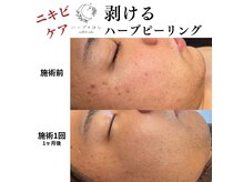 ハーブのほしの雰囲気（剥けるハーブピーリング！結果重視◎男性のお客様も増えてます♪）