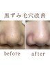 当店1番人気【毛穴黒ずみ改善×炭酸ヘッドスパ】120分  ¥17600 → ¥13200