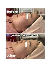 ティアラ(TIARA)/【毛穴、産毛】ワックス脱毛