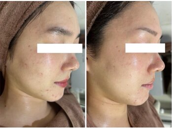 ホワイトアクア 四日市店(WHITE AQUA)/ニキビケア/四日市ハーブ