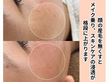 リアン(LIAN)/産毛ツルツルコース