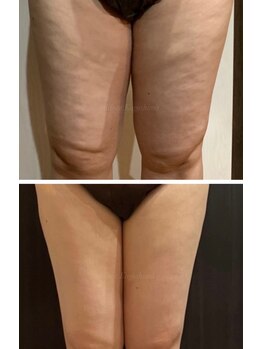 ミーラブ 鹿児島(miilove)/40代太ももの凹凸セル改善ケア