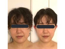 ハイコガオ(HIKOGAO)/小顔矯正40分