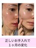 【目指せノーファンデ】韓国施術セルマン￥22,000→￥11,000