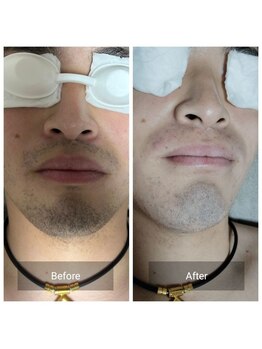 スリール(sourire)/ビフォーアフター