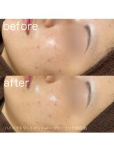 ルルラ リコ(lulula rico)/症例写真/ハーブピーリング