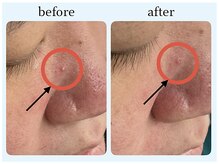 マーレ(Mare)/大人ニキビ部分改善