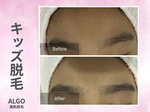 アルゴ 山口宇部店(ALGO)/キッズのお顔脱毛