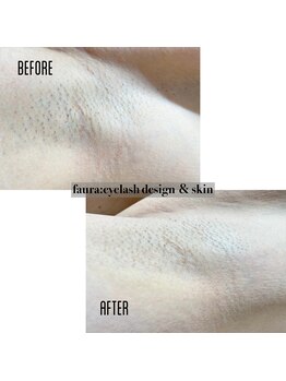 ファウラ(faura:)/全身脱毛