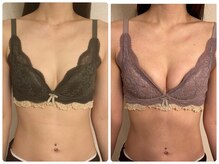 プリマ(prima)/バストアップ症例