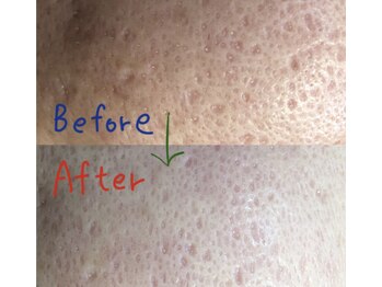 ヴィーナス(Venus)/最新ハイドラフェイシャル