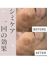 エステティック エイチアンドビー 大和店(H&B)/シミケア　フェイシャル