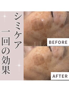 エステティック エイチアンドビー 大和店(H&B)/シミケア　フェイシャル