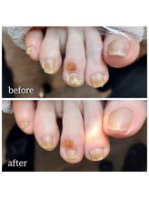 爪切り屋 足楽/トラブル原因は靴と浮指です