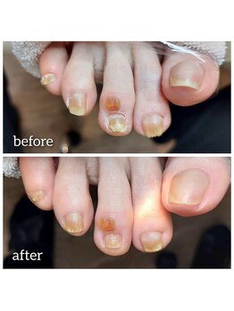 爪切り屋 足楽/トラブル原因は靴と浮指です