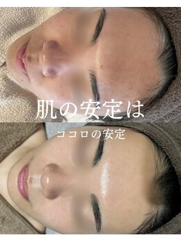 インテリウス(INteRius.)/安定した肌