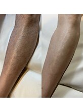 ディシェル(D cier)/【メンズ脱毛】脚脱毛