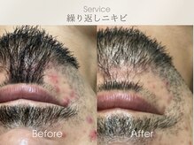 ベルダ(BELDAD)/【繰返しニキビケア！】