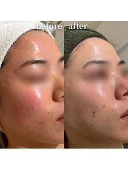 エステティックサロン ナチュラーレ/ニキビ・凸凹感・赤み