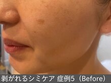 オアシスラグーン(OASIS LAGOON)/シミケア（症例5 before）50代