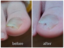 爪切り屋 足楽/【爪の下の魚の目】