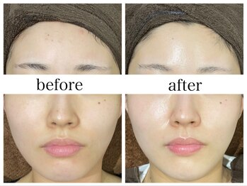 アリエスの写真/【６回で別人級】美容液毛穴洗浄ハイドラと皮膚科医監修エレクトロポレーションで叶える極上毛穴レス艶肌