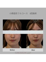 リュクシー(LuxeY)/20代小顔造形フルコース 1回施術