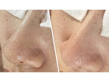 毛穴専科/白玉艶肌へ♪那覇