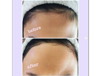 サンテ(Sante)/おでこの生え際ビフォーアフター