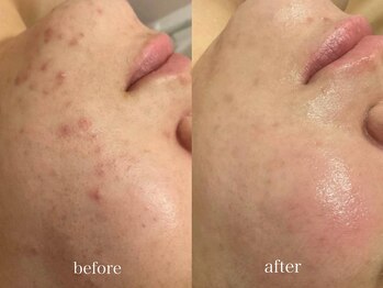 グランヴェルジェ(Granverger)/陶肌トリートメント6回