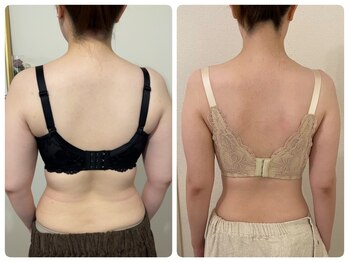 モナンジュ(ramonange)/背中のbefore after