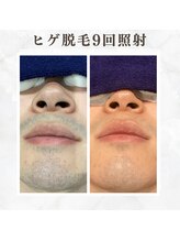 ボゴス(BOGOSS)/ヒゲ脱毛９回照射