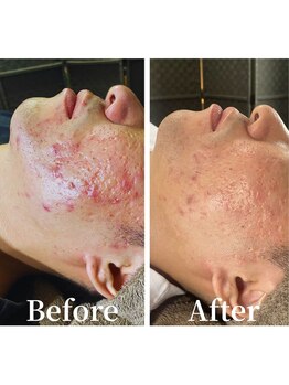 デン(DEN)/ニキビケア