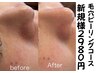 【超毛穴・肌管理】その場でわかる毛穴綺麗