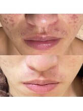 ウイユ(Oeil)/剥けるハーブピーリング効果3回