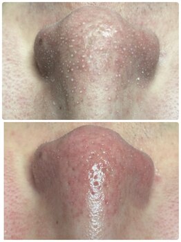 プリエ(Prier)/毛穴丸ごと洗浄