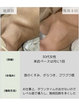 サロンエヌ 久留米店(Salon N)/首のシワ◎